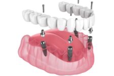All-On-4 Dental Implants Everything You Need to Know Banner
